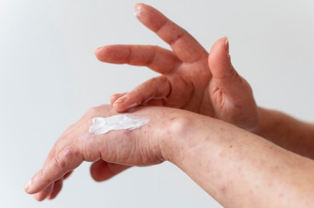 Treat bug bites with first aid kit and creams and lotions